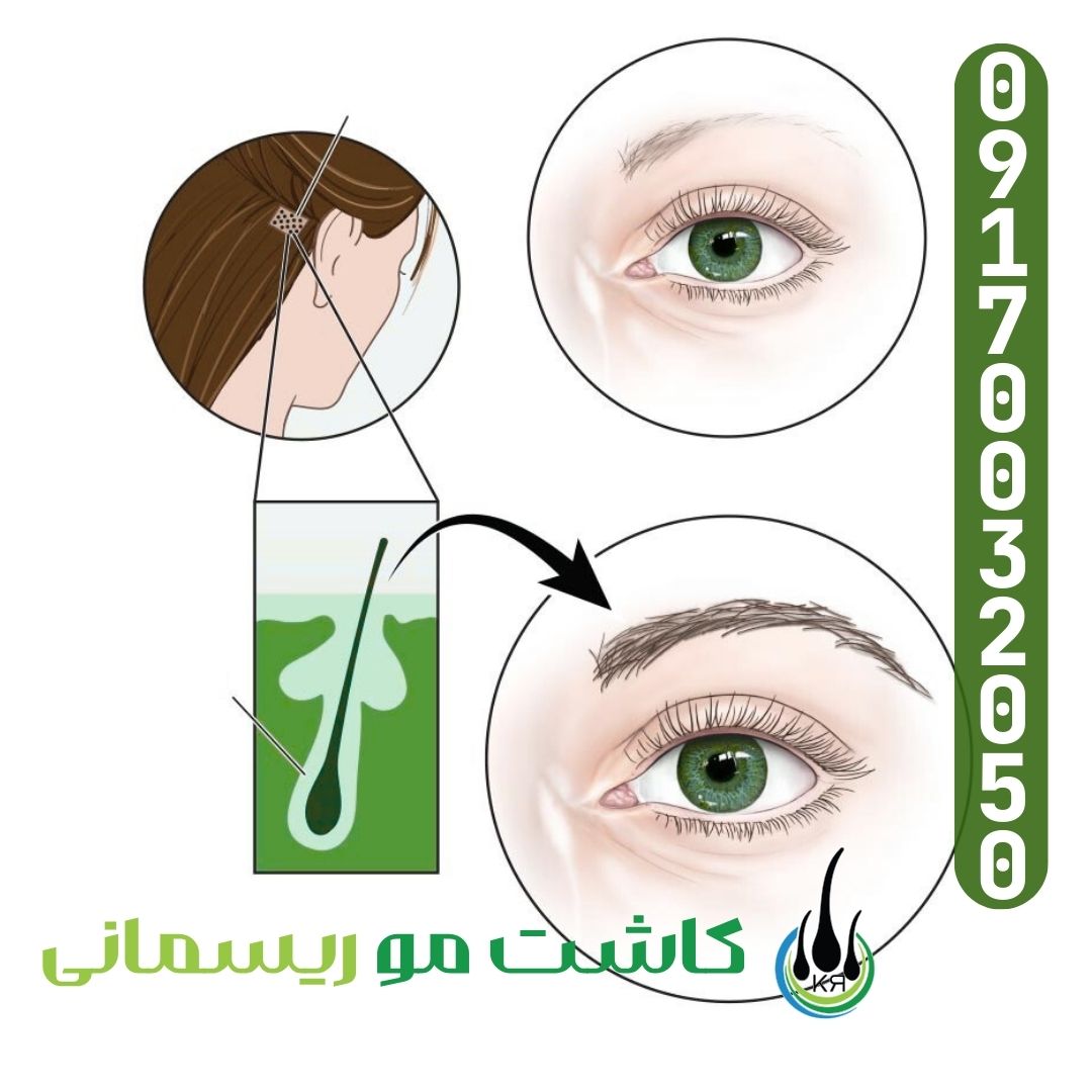 برای کاشت ابرو از کجا مو برمیدارن