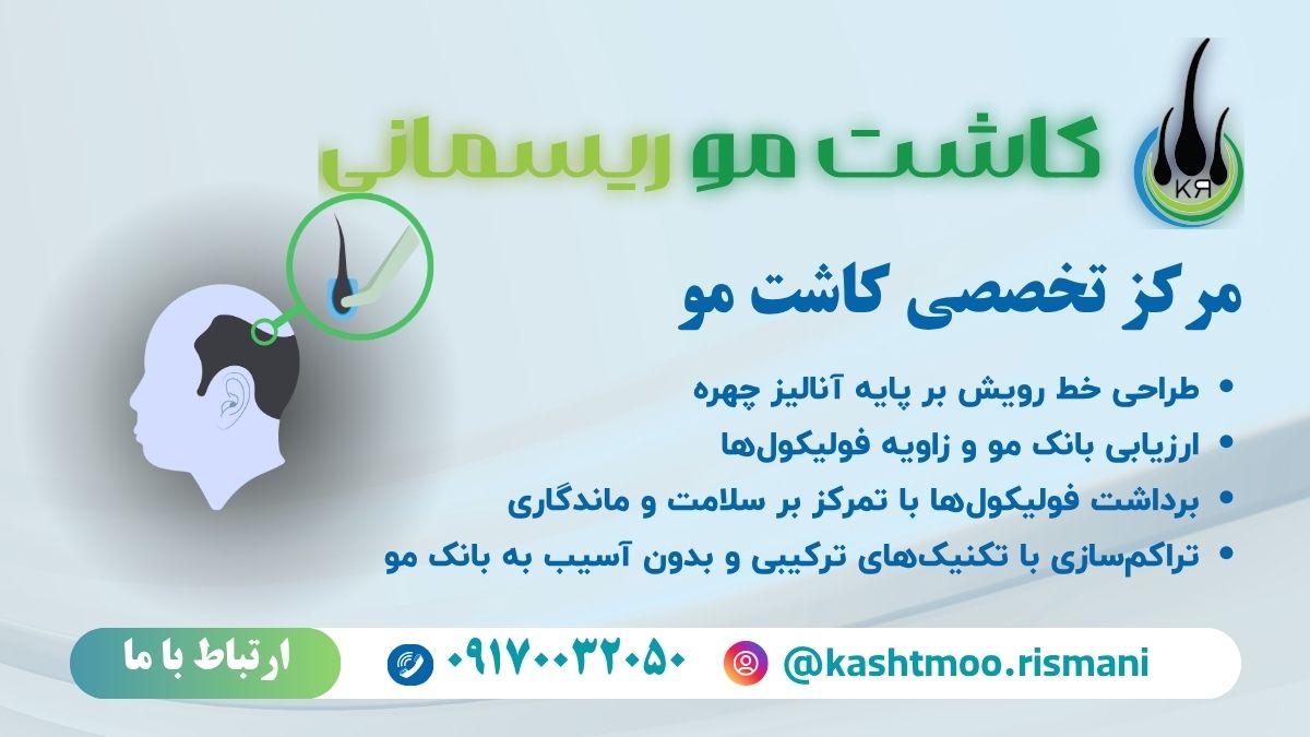 کاشت مو ریسمانی کاشت مو ریسمانی