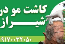 کاشت مو در شیراز