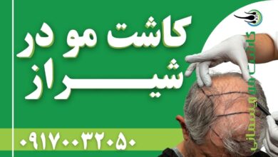 کاشت مو در شیراز