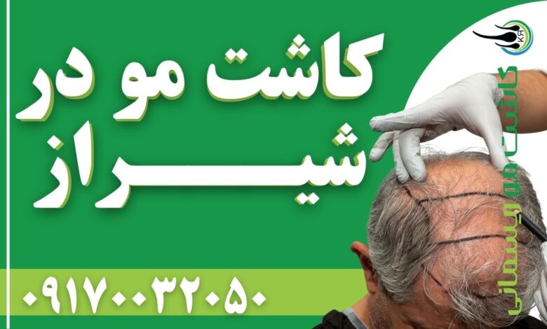 کاشت مو در شیراز