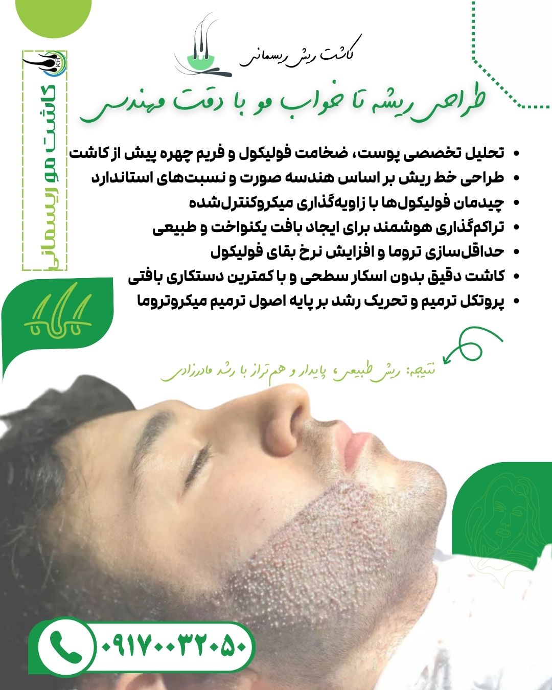کاشت ریش و سبیل ریسمانی کاشت ریش و سبیل ریسمانی